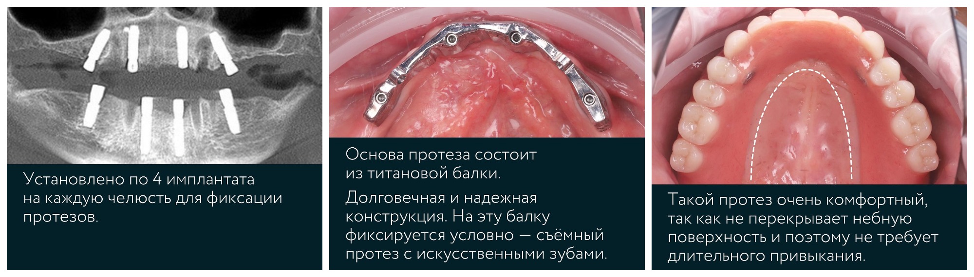 Виды протезирования зубов и зубных протезов