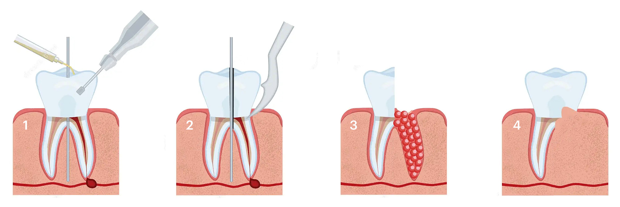 Операция гемисекции зуба. Гемисекция зуба инструменты. Зубосохраняющие операции в стоматологии. Зубосохраняющая операция