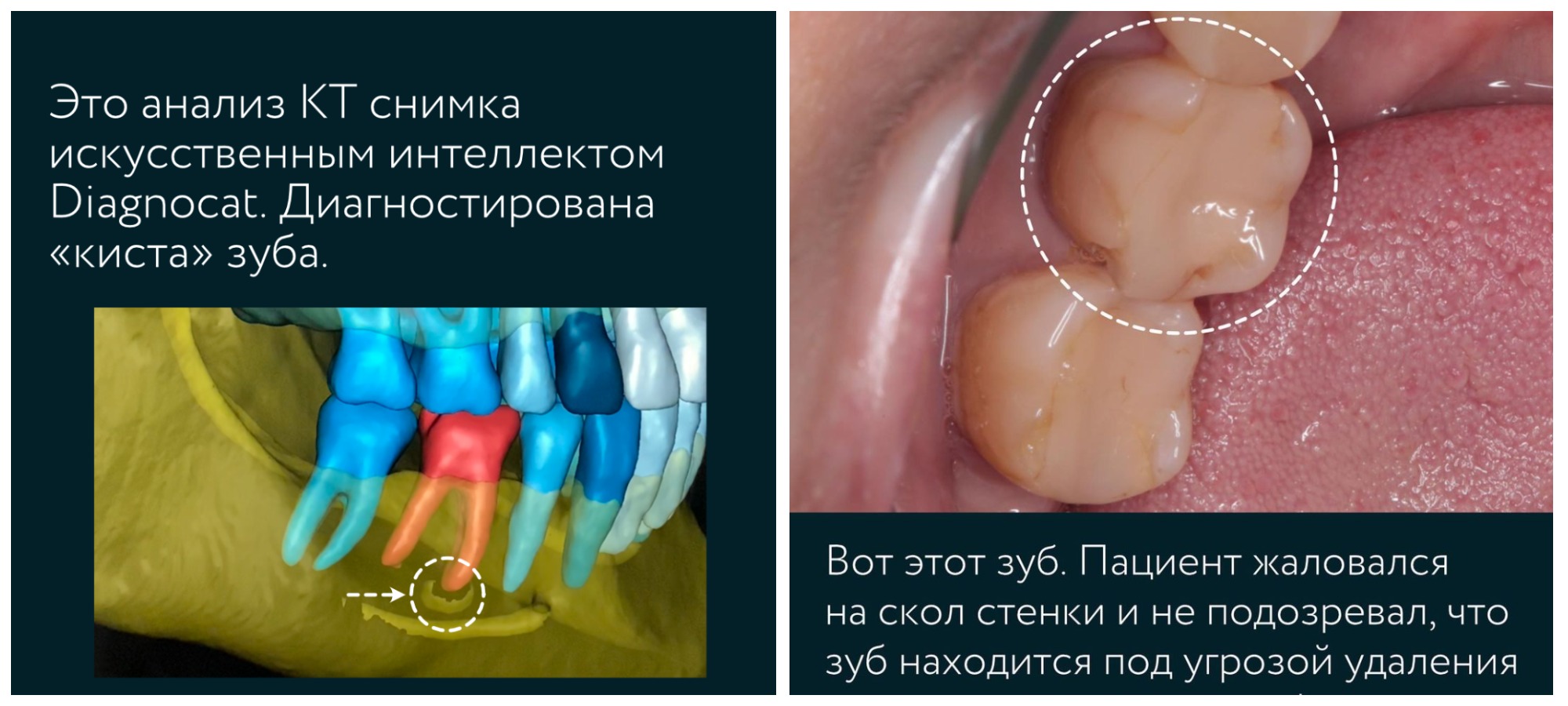 Удаление кисты без удаления зуба — хирургические методы