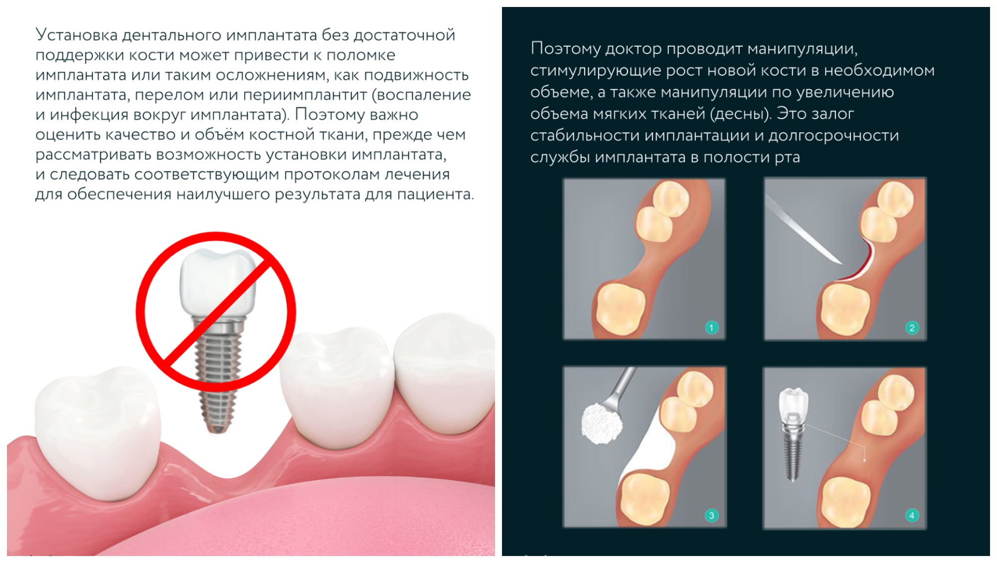 Имплантация костной ткани