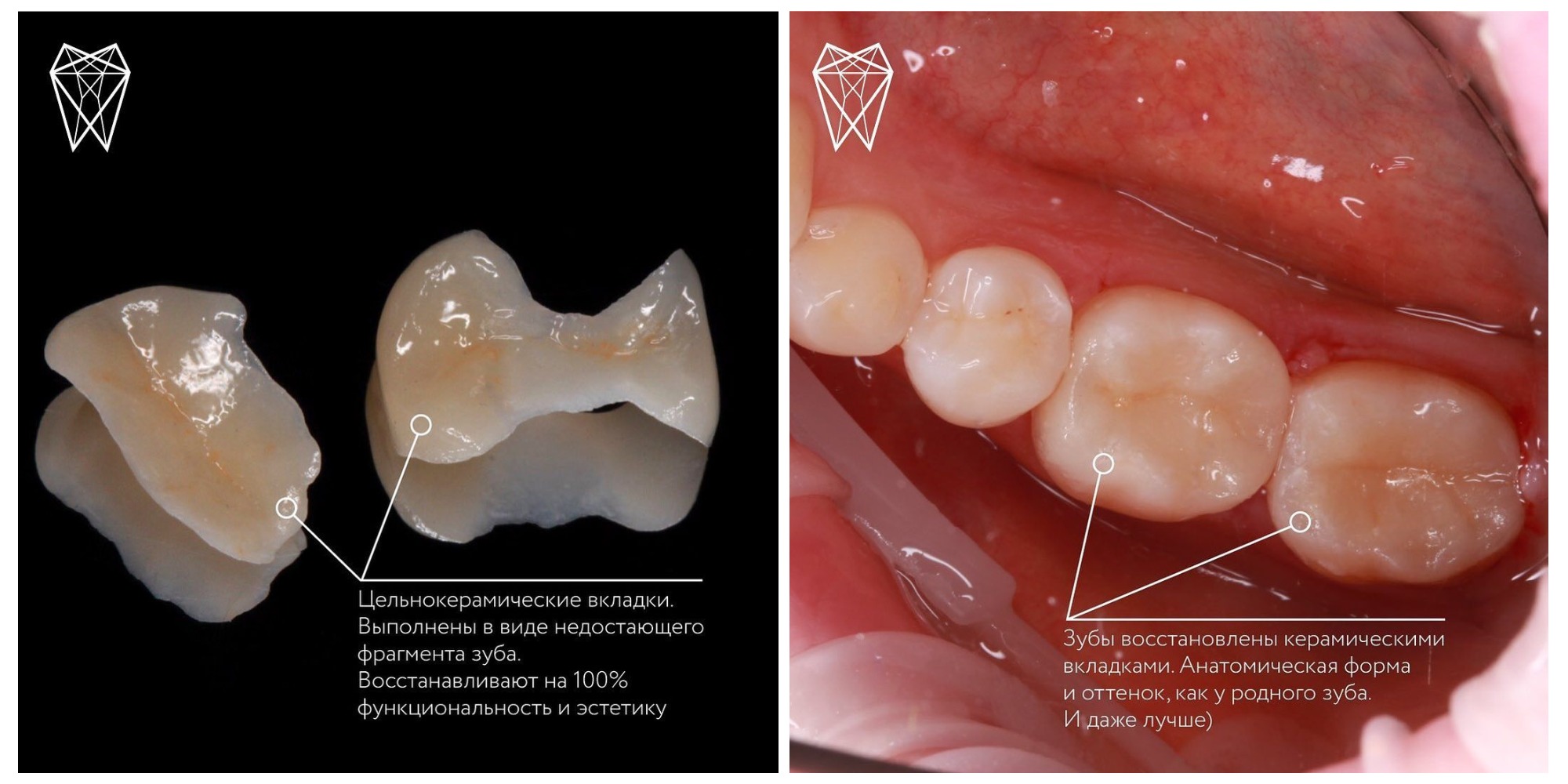 Зачем нужны слепки зубов для протезирования, из каких материалов их создают