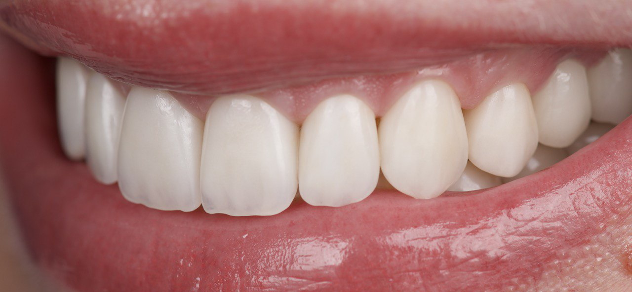 Устранение повышенной чувствительности зубов и установка виниров