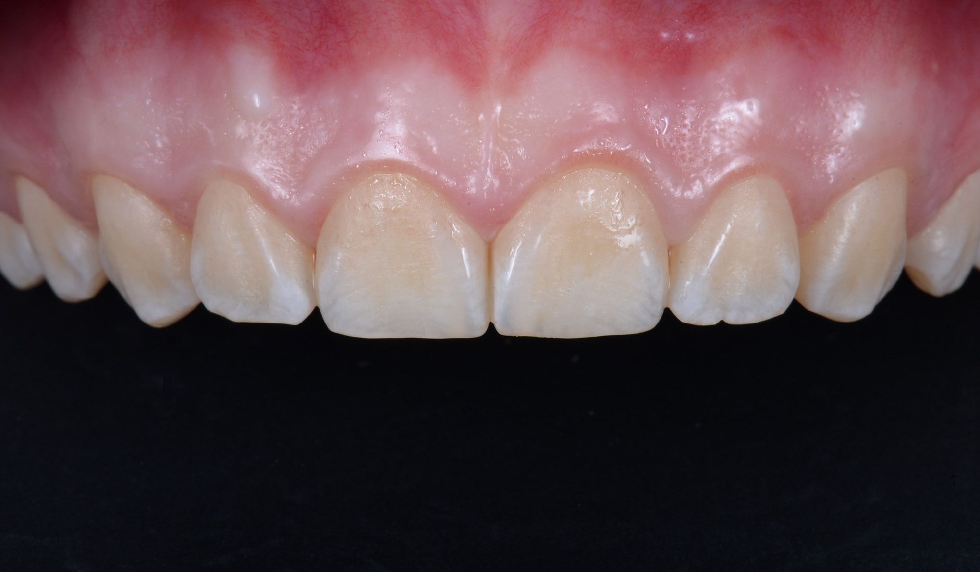 Восстановление зубов керамическими винирами (девушка, 25 лет)