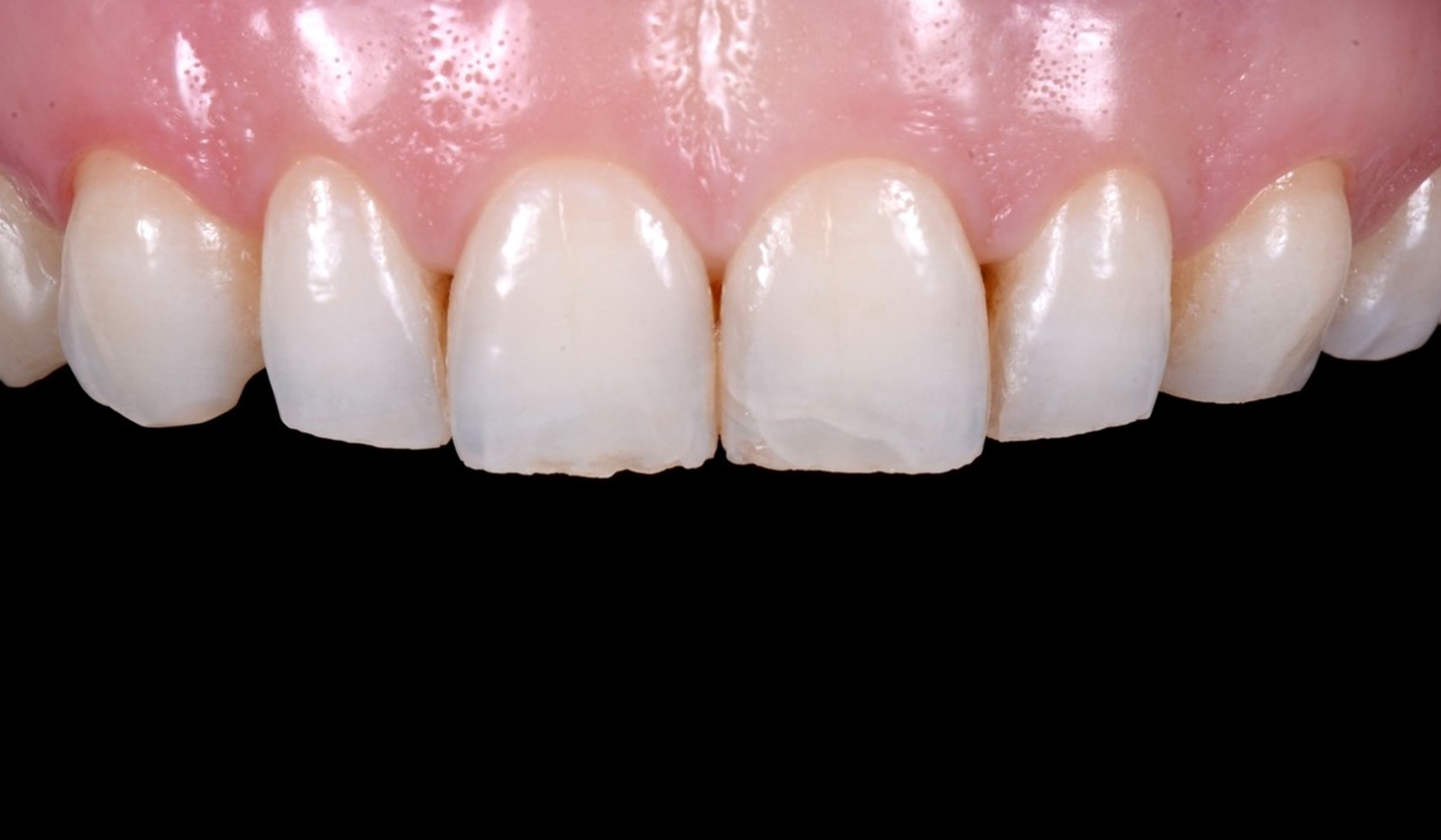 Восстановление зубов керамическими винирами
