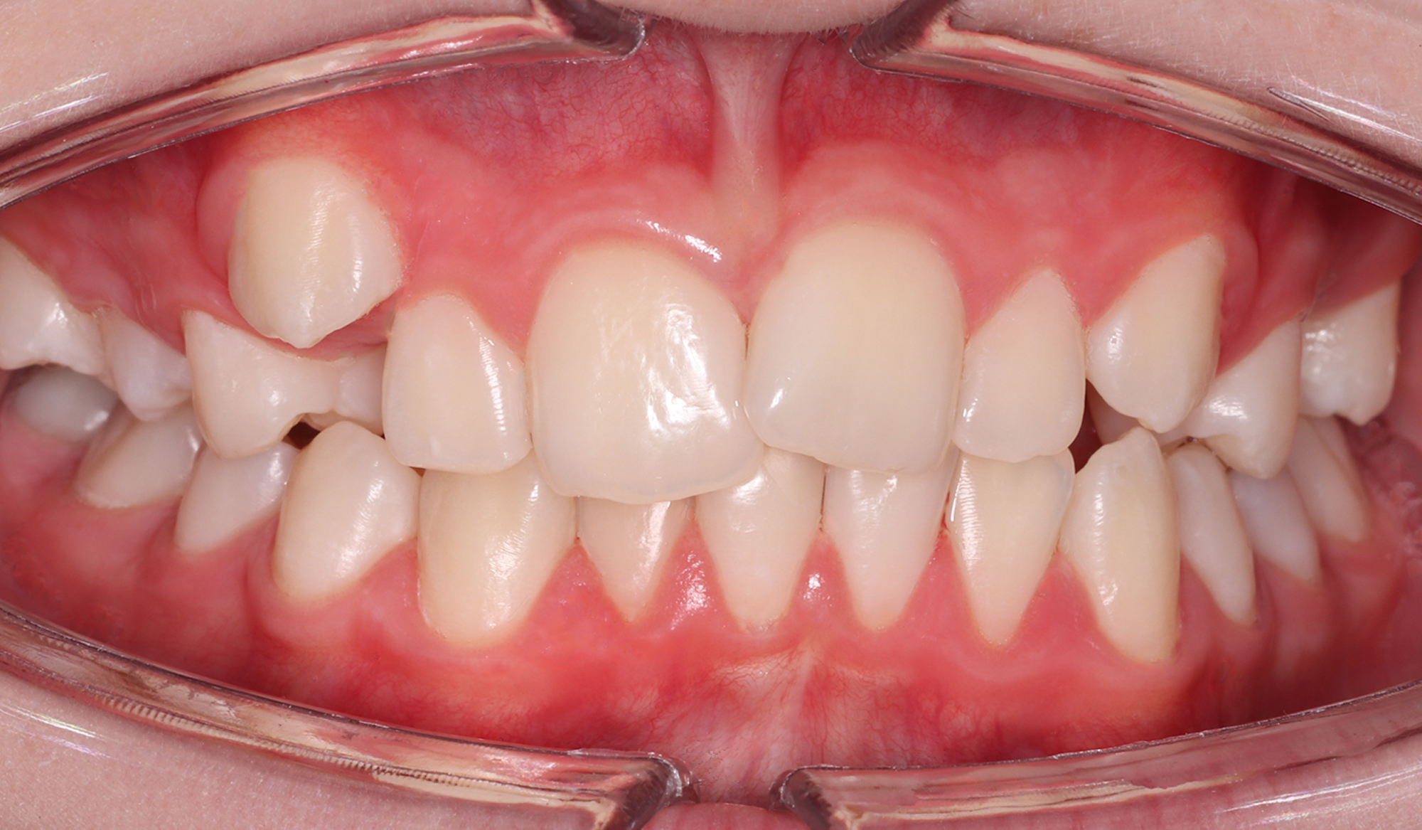 Выравнивание зубов с помощью брекетов
