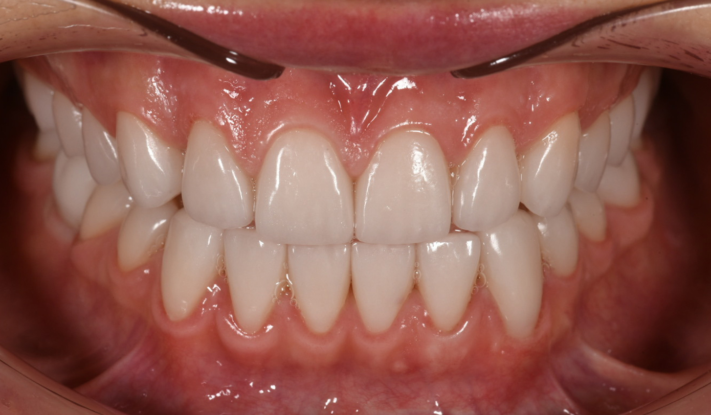 Восстановление зубов керамическими винирами и коронками