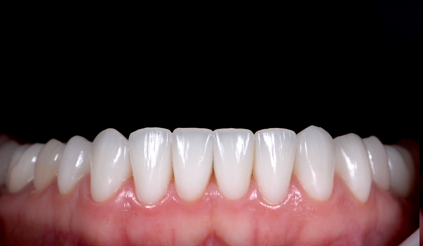 Восстановление зубов керамическими винирами за 6 визитов