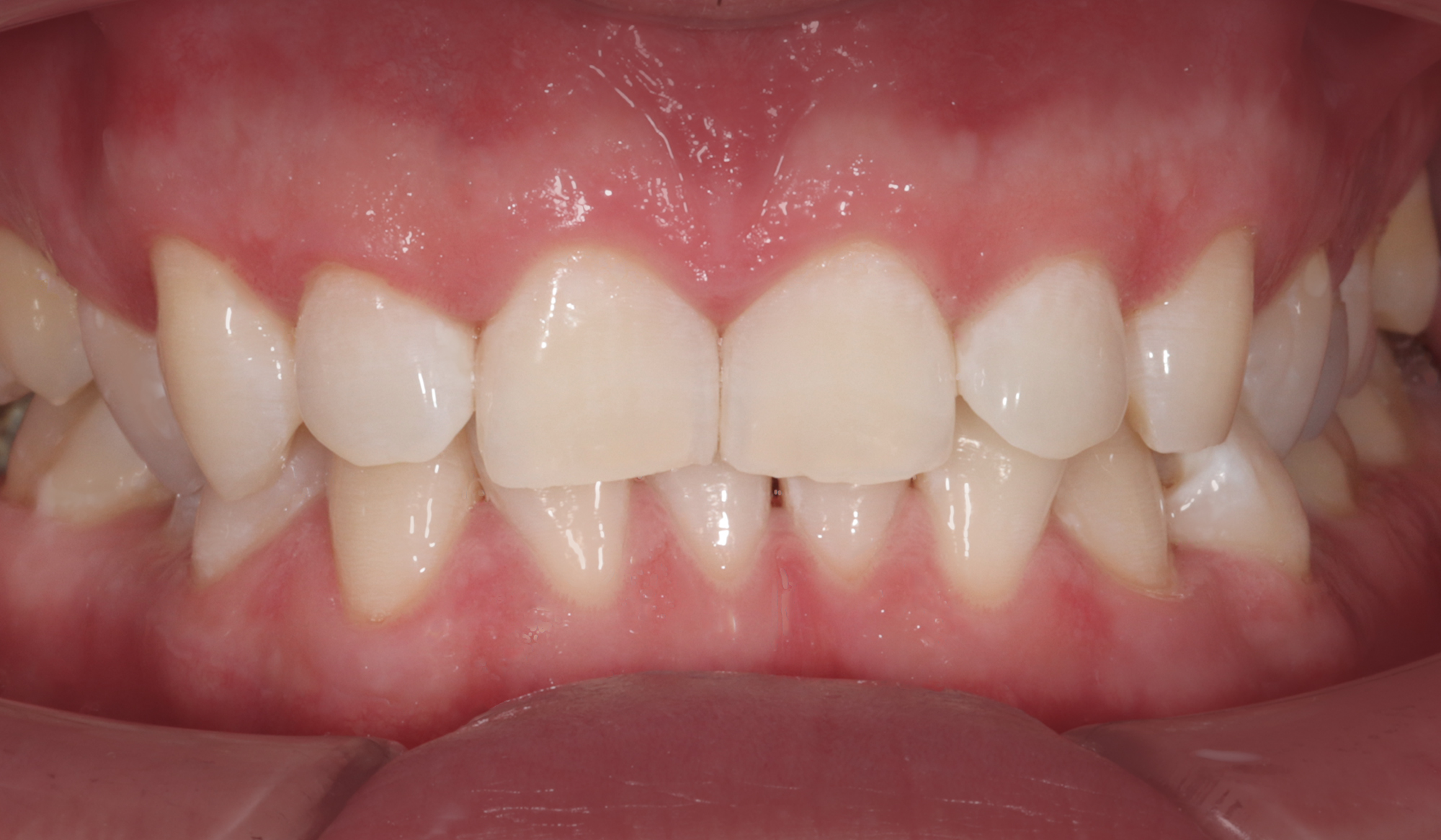 Профгигиена + отбеливание зубов Opalescence Boost