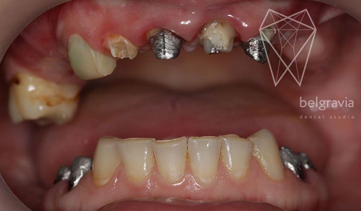 Лечение зуба без вмешательства хирургического