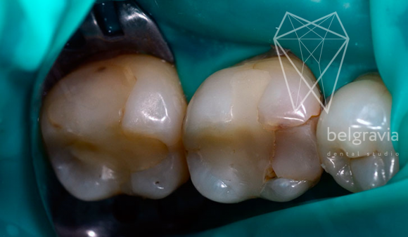 Лечение кариеса с восстановлением зуба керамическими вкладками. До лечения
