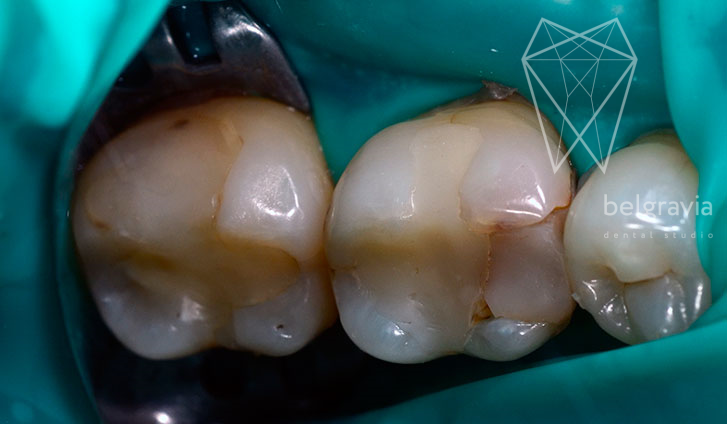 Лечение кариеса с восстановлением зуба керамическими вкладками. До лечения