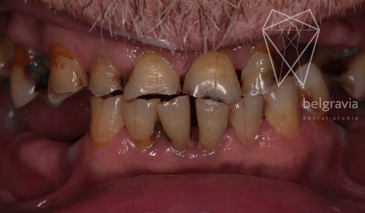 Одномоментная имплантация зубов: цены и особенности