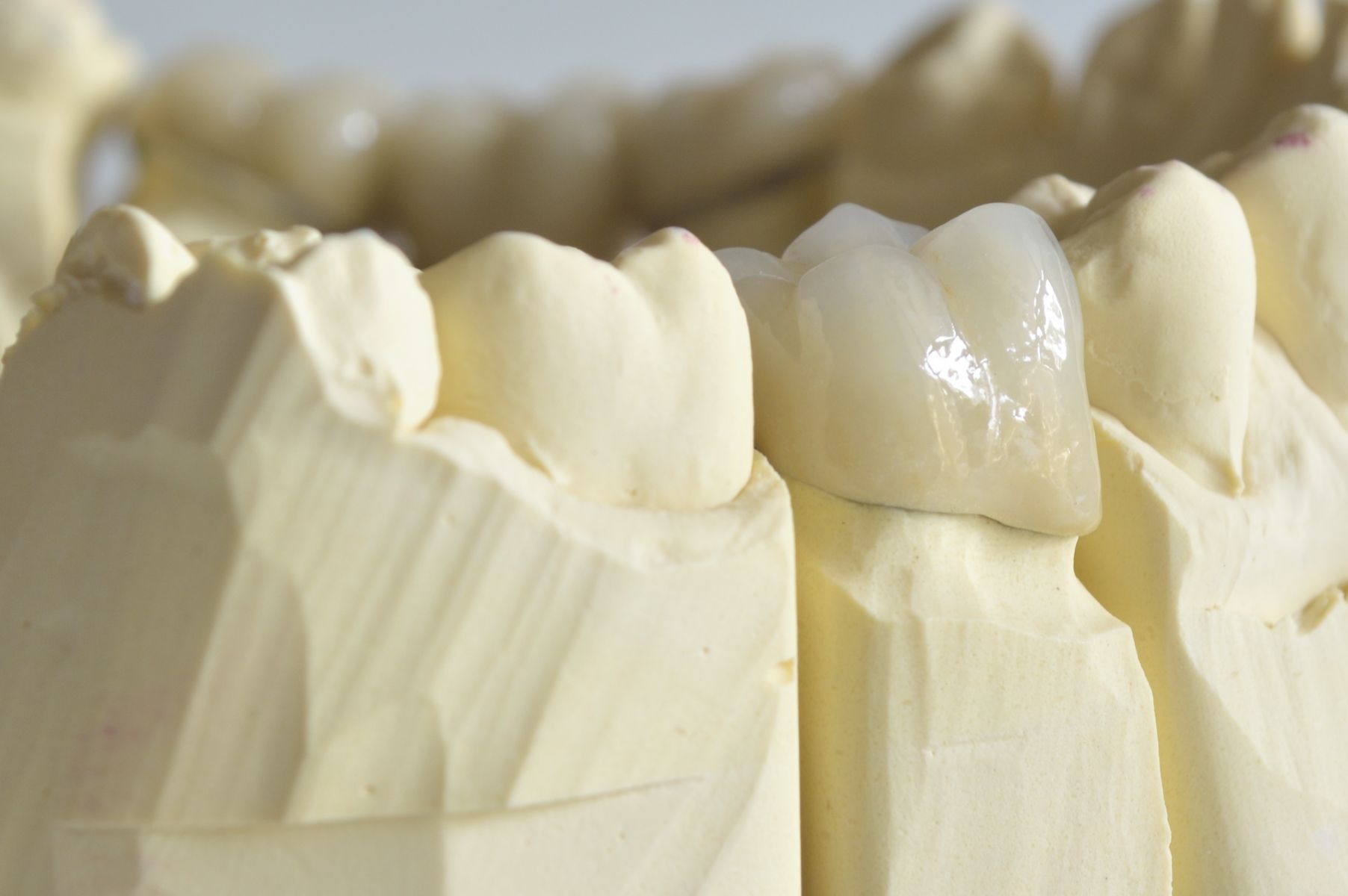 Протезирование зубов без обточки