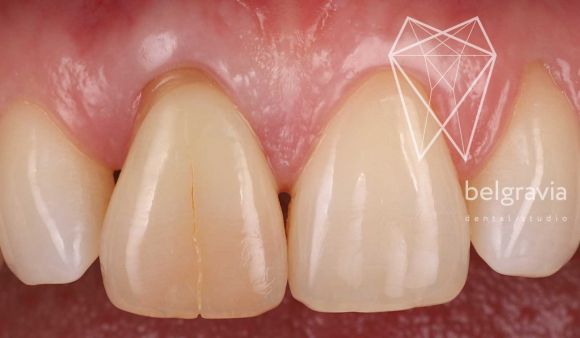 Вопросы по восстановлению зубов