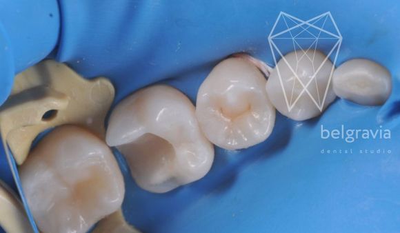 Микропротезирование (реставрация зуба керамической вкладкой). 1 этап: лечение кариеса и снятие слепков