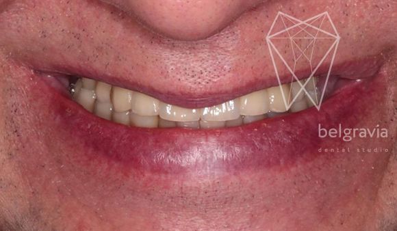 На нижней челюсти терапевтическое перелечивание зубов, установка 2 имплантатов, восстановление всех зубов коронками.