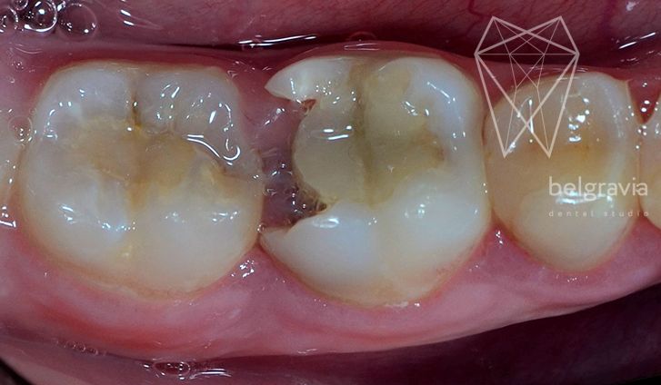 Аутотрансплантация - пересадка собственного зуба. Фото до лечения.