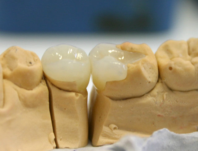 Вам восстановили зуб керамической вкладкой. Что важно?