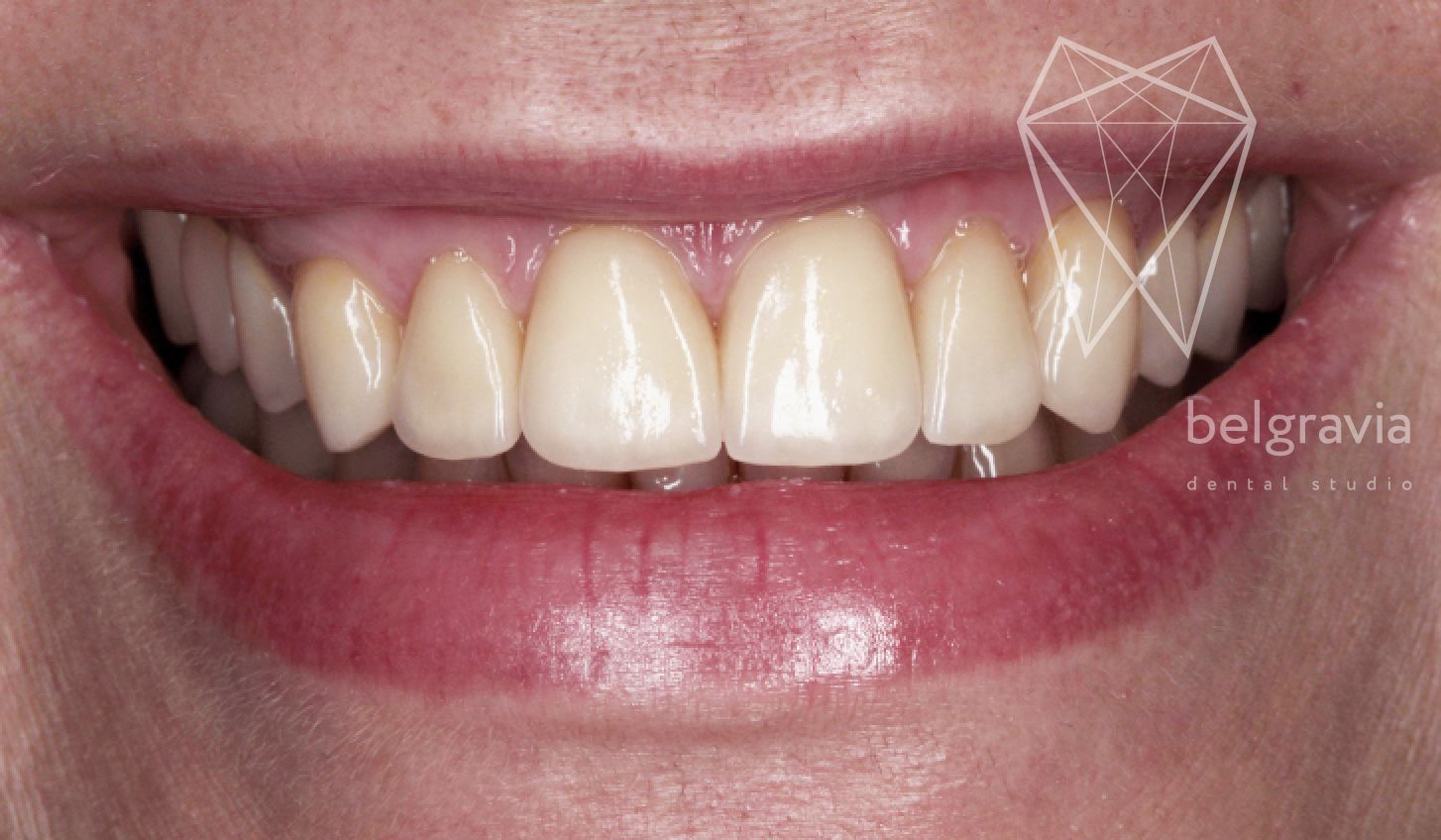 диоксид циркония коронки фото зубов