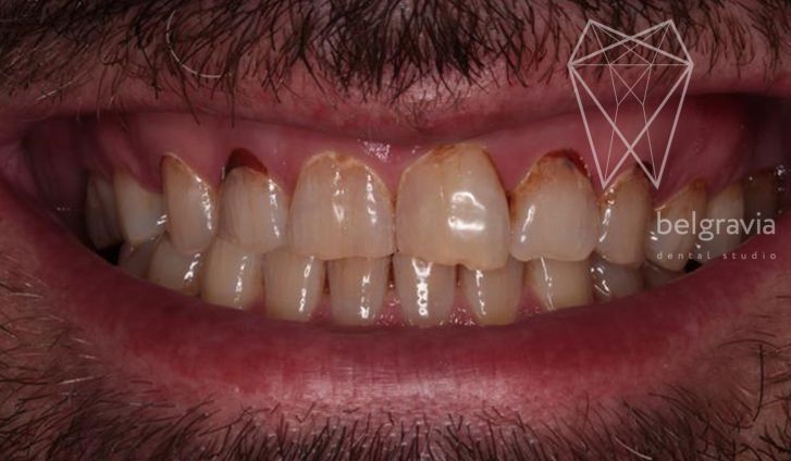 Доктор зубов лечение кариеса