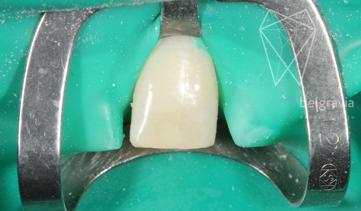Миниинвазивная реставрация центрального зуба без бормашины