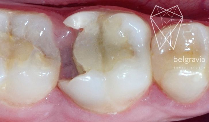 Что такое канал в зубе?