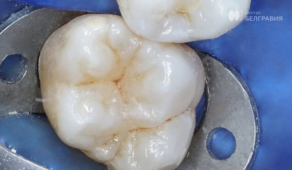 Замена старой пломбы на новую реставрацию.