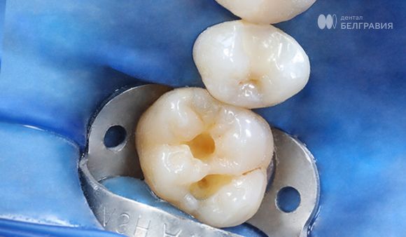 Замена старой пломбы на новую реставрацию.