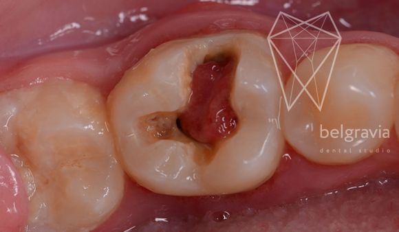 Аутотрансплантация - пересадка собственного зуба. Фото до удаления