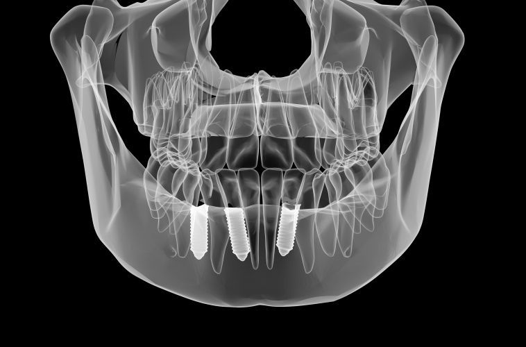 Имплантация зубов 3D - качественные зубные импланты