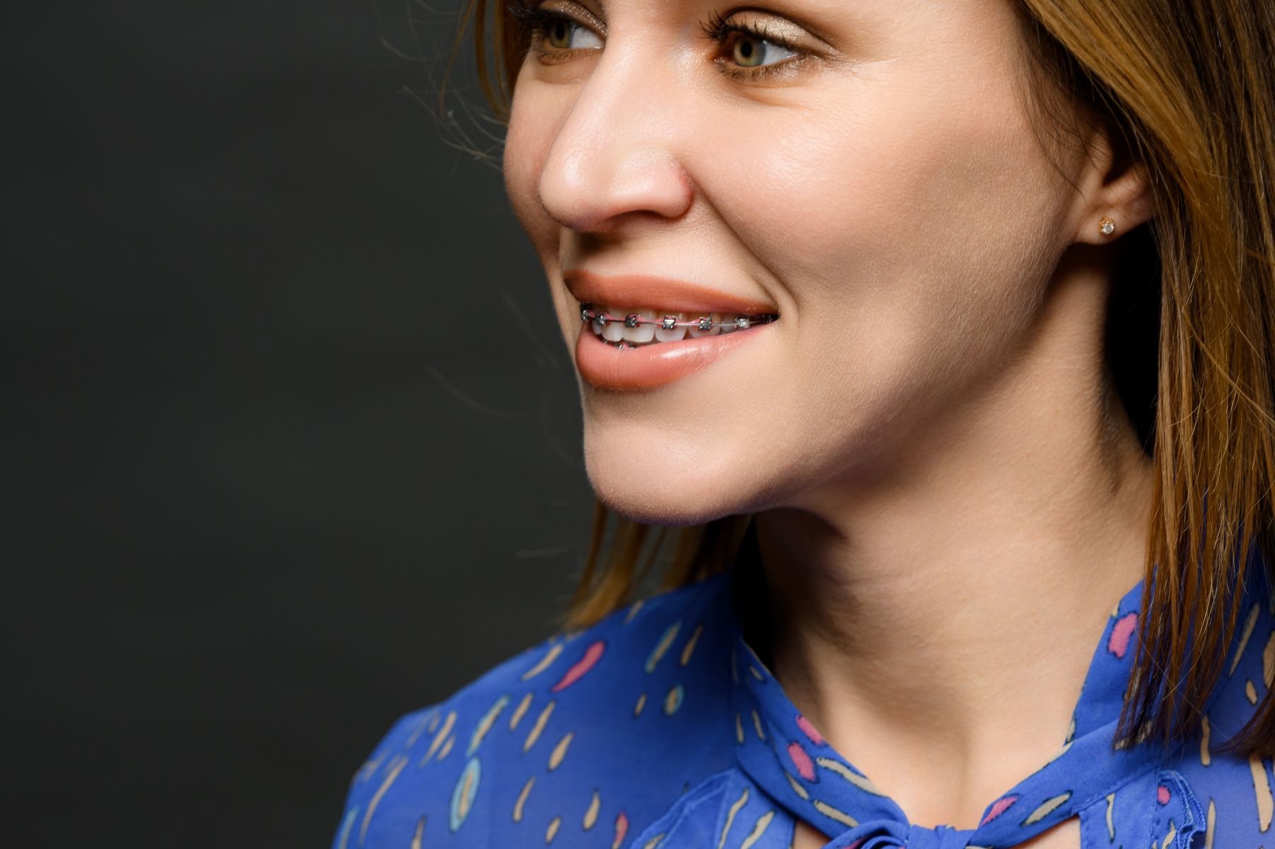 5 мифов об исправлении прикуса у взрослых