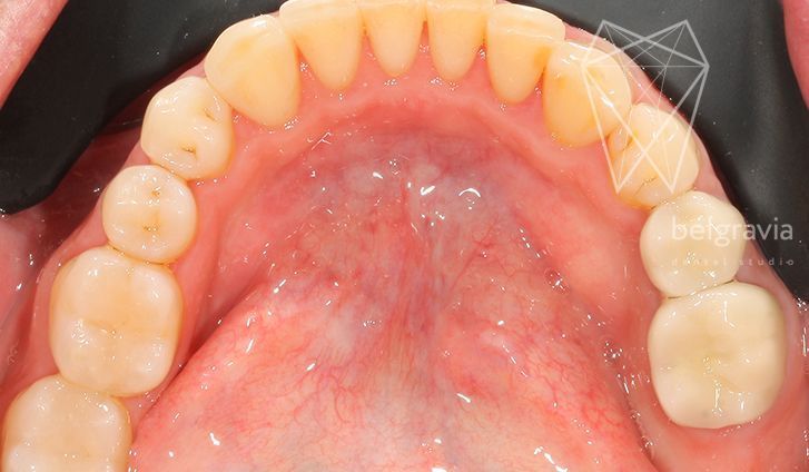 Первый этап комплексного лечения - терапия (лечение кариеса, лечение каналов, реставрация зубов)