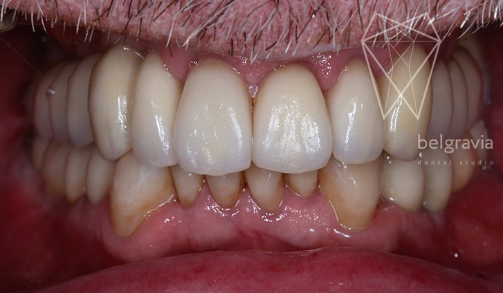 Лечение зуба без вмешательства хирургического thumbnail