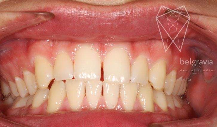 Профессиональная гигиена полости рта: чистка зубов