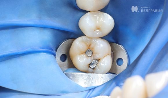 Замена старой пломбы на новую реставрацию.