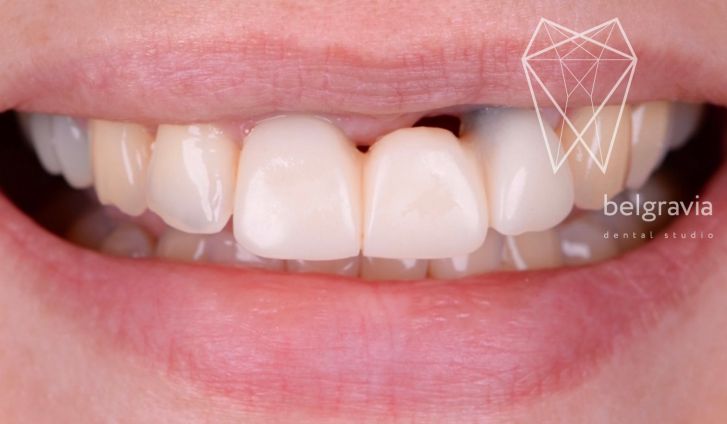 Протезирование зубов: сроки после удаления, привыкание, уход за протезами