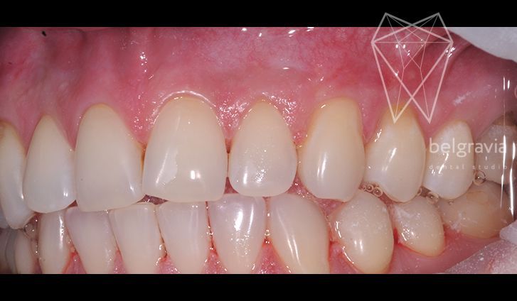 Ушиб зуба: возможные последствия и лечение
