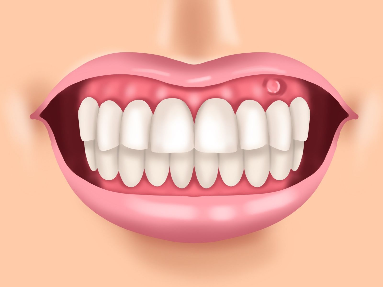 Гнойник на десне