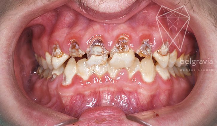 Хирургическое лечение зубов москва