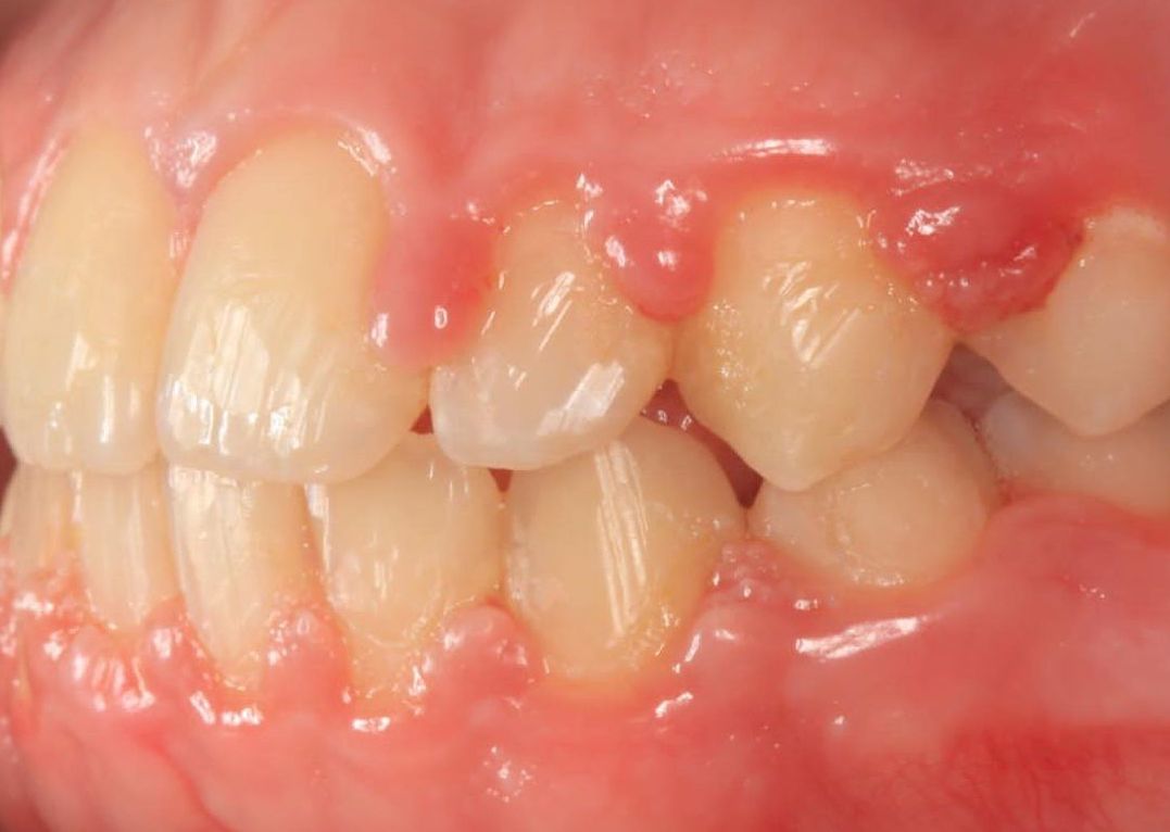 Опухла десна. Что делать?