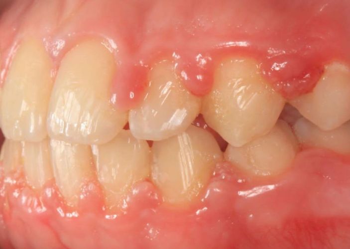 Опухла десна возле зуба: что делать и как лечить