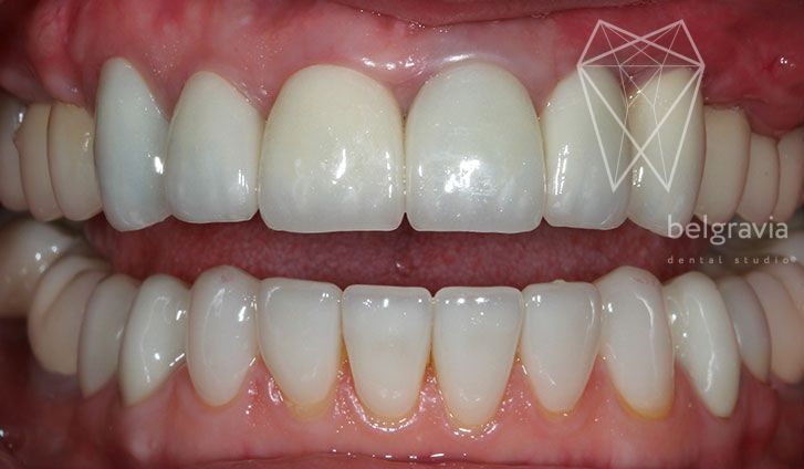 Лечение зуба без вмешательства хирургического