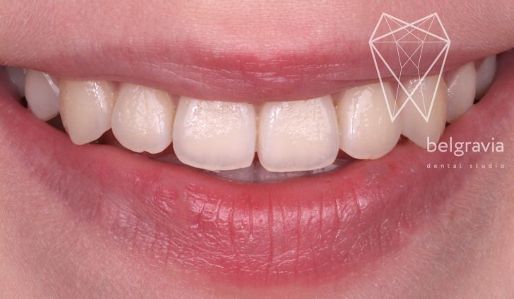 Какие бывают искривления зубов?