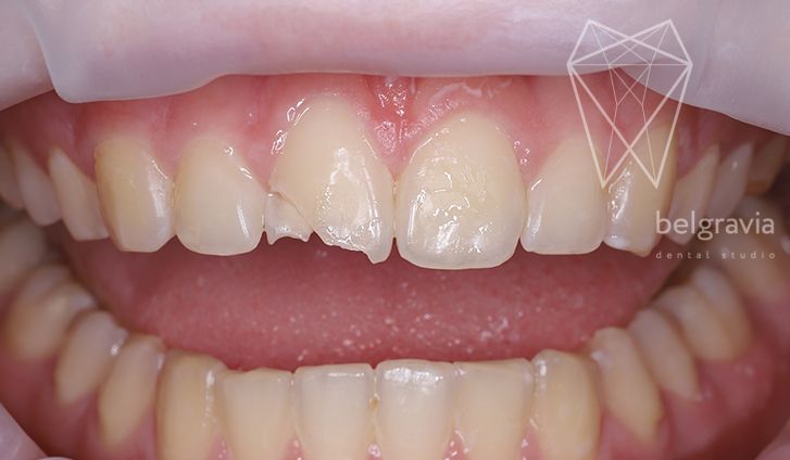 Варианты восстановления зубов