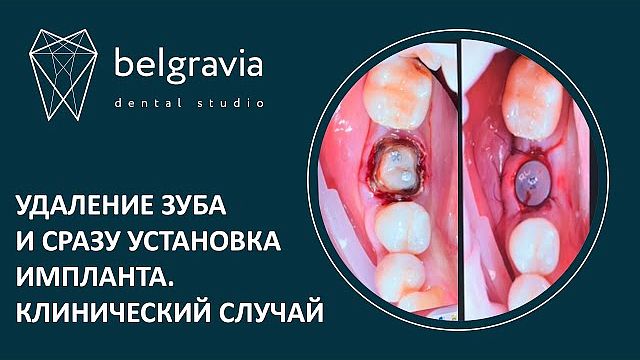 Удаление зуба с коронкой и одномоментная имплантация. Клинический случай