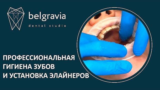 Профессиональная гигиена зубов и установка элайнеров