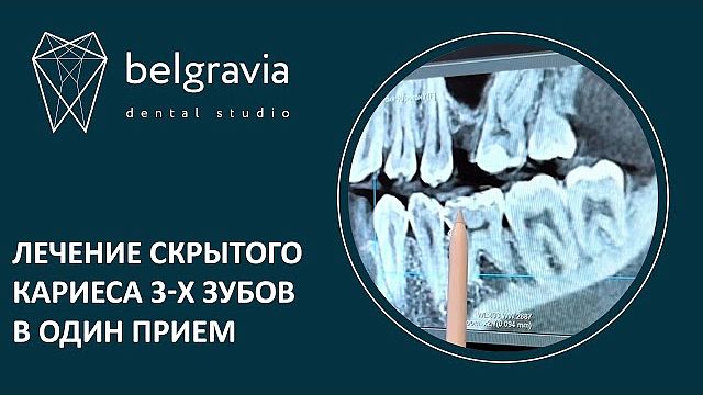 Лечение скрытого кариеса 3-х зубов в один прием