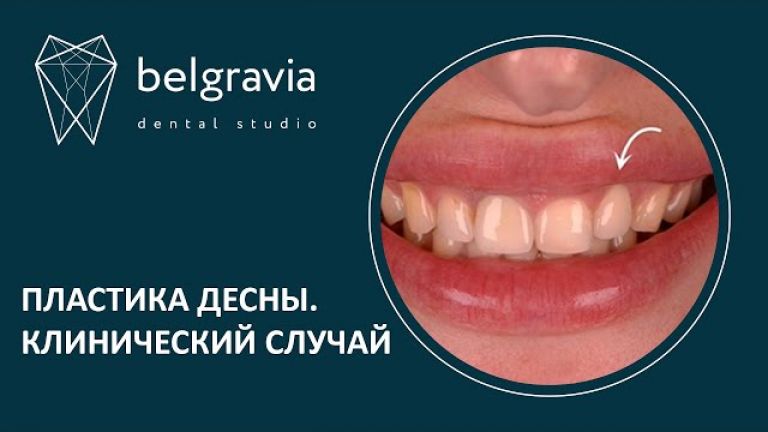 Пластика десны. Клинический случай стоматологии Belgravia Dental Studio